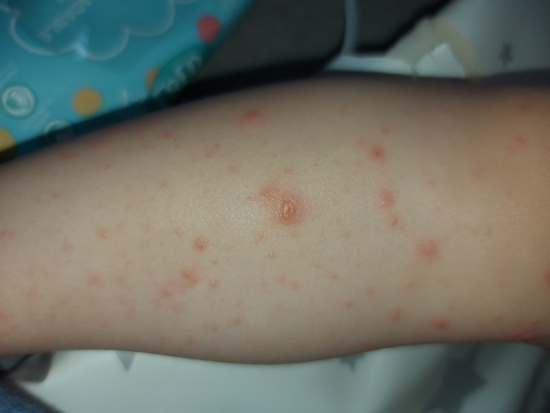 Chickenpox?