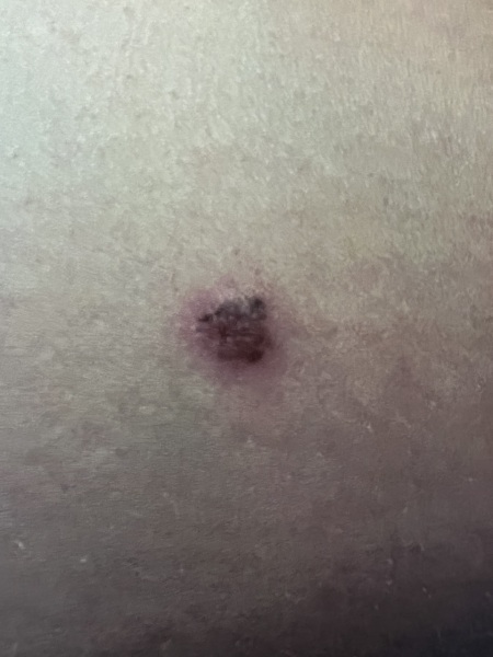 Suspicious mole