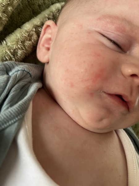 CMPA help !