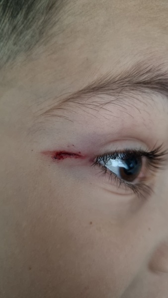 Cut near eye - does this need looking at?