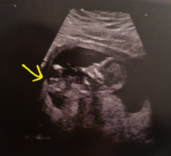 Is this the nub?