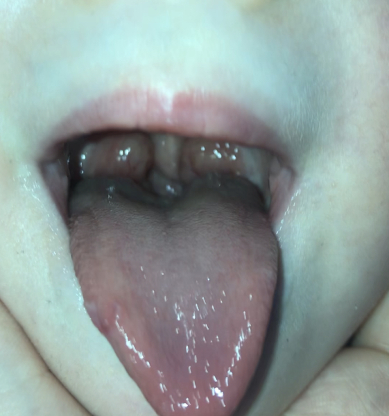 (Pic of inside mouth) These aren’t normal tonsils are they? (2 y/o DD)