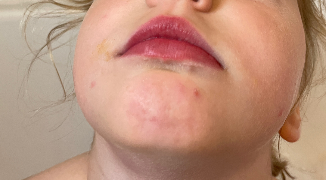 Chicken pox but vaccinated