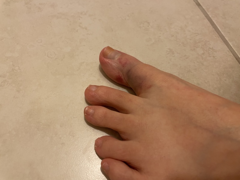 Wtf has happened to my toe? (with non-gross pics)