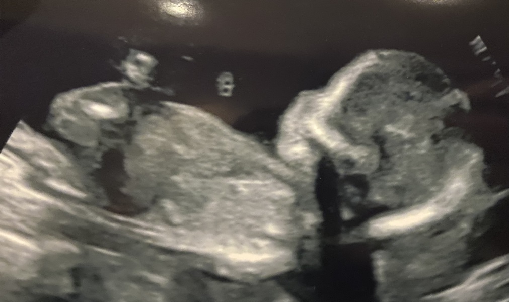 Boy or girl?