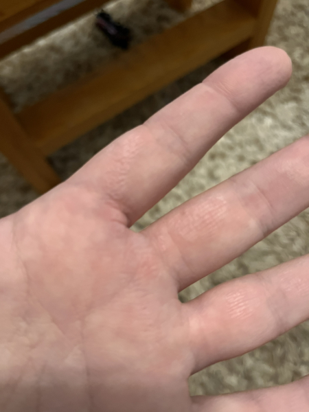 Anyone grabbed a scalding hot pot handle? Help!