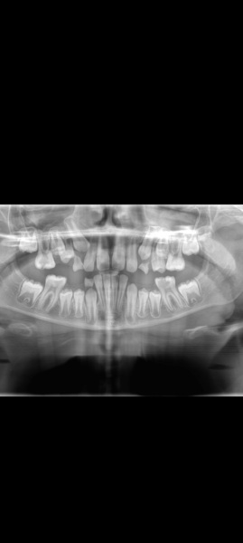 Root canal V extraction