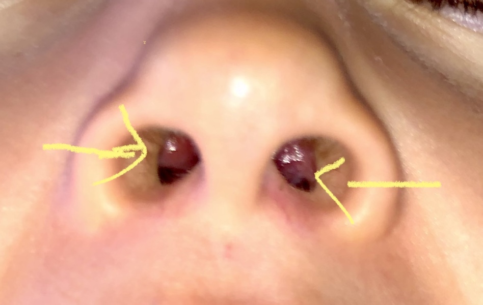 Panicking about nasal growths