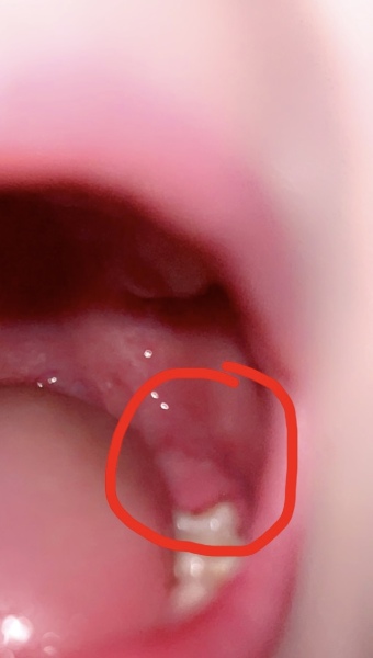 Sore Gum HELP