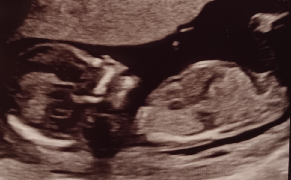 I think baby looks like a girl, do you agree?