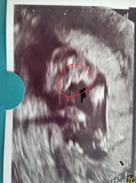 Gender help -19 week 2 days