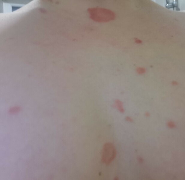 Can anyone help - is this pityriasis rosea??