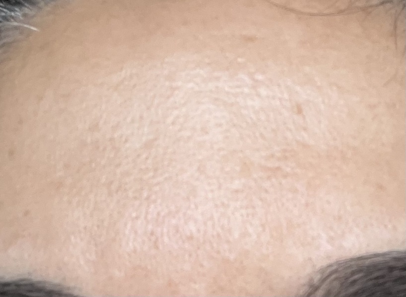 37 forehead worries