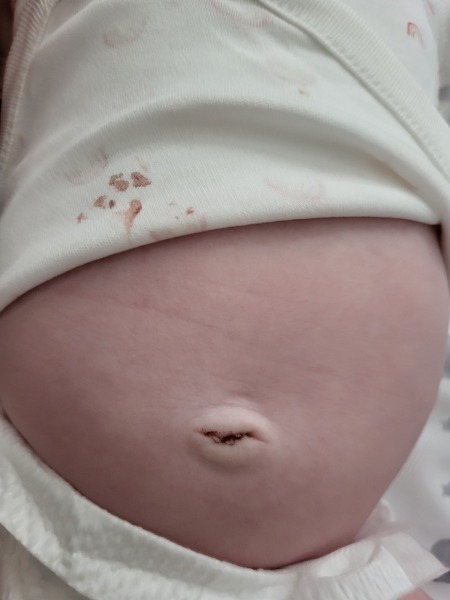 11 week old belly button