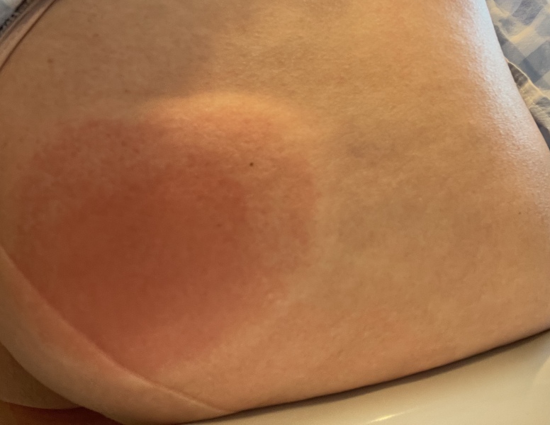 Something stung me in my bum!  (TW: pic included sorry)
