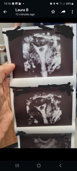 Fluid in uterus ?
