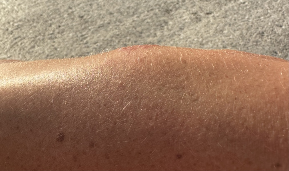 What is this? With pics. Eczema / Ringworm / psoriasis?
