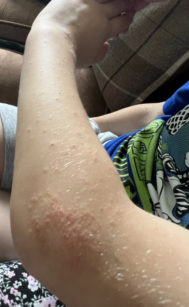Is this eczema? Pic included!