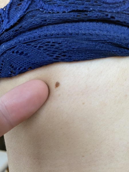 Angry I can't get an appointment with Gp. Pic of mole