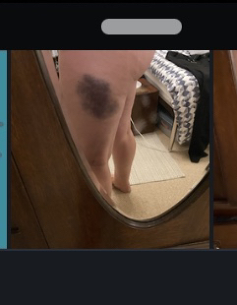 BIG bruise - or haematoma?