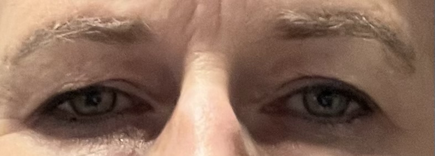Upper eyelid surgery (Kent) -£3500??