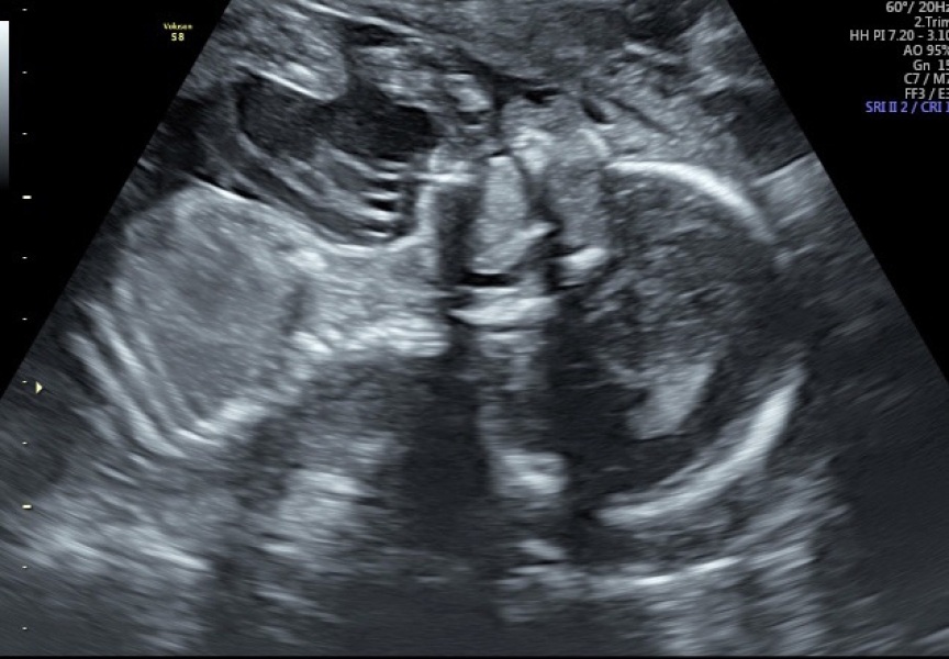 Boy or girl, guesses ?!
