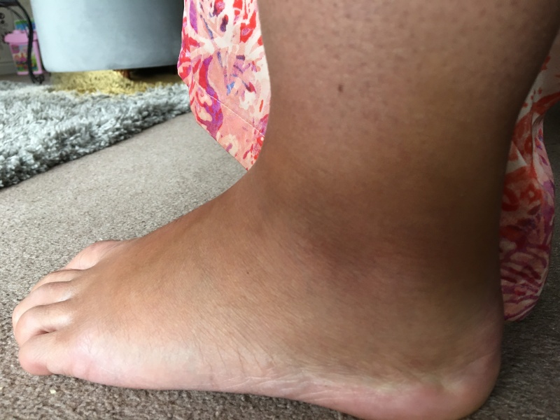 Does this look like a bad sprain to you?