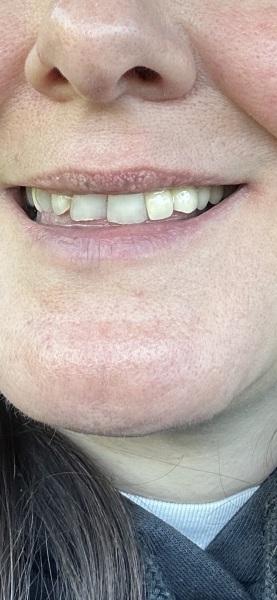 Permanent crown looks worse that temporary