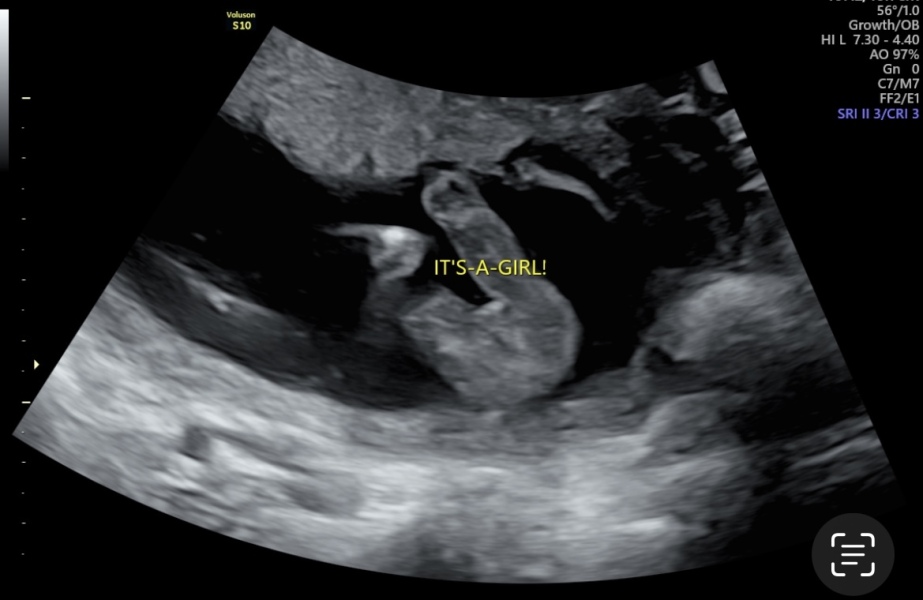 Gender scan at 15W6D accuracy?