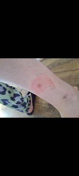 Lyme's disease diagnosis
