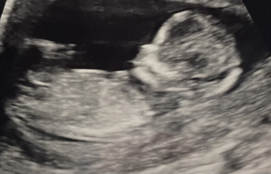 After 3 girls! NUB SCAN PIC advice please!
