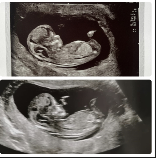 Siblings Scan Identical - same gender?!