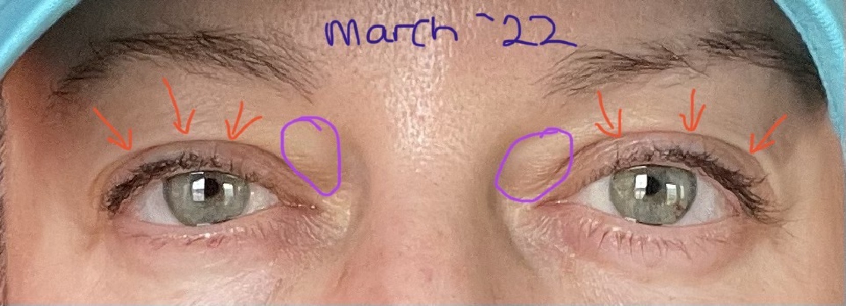 Upper Blepheroplasty