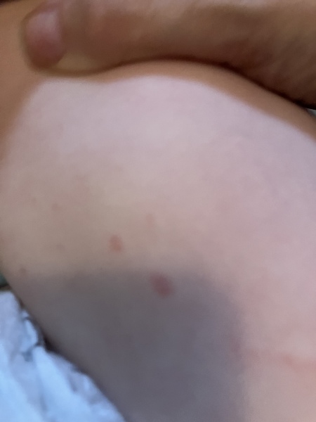Chicken pox just before Europe holiday