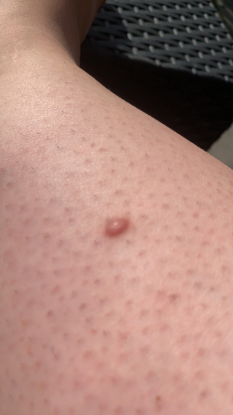 Can i get this ingrown hair removed at doctors? Pic included!