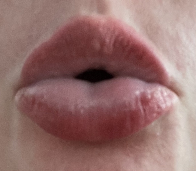 Anyone had this reaction before? *pics*