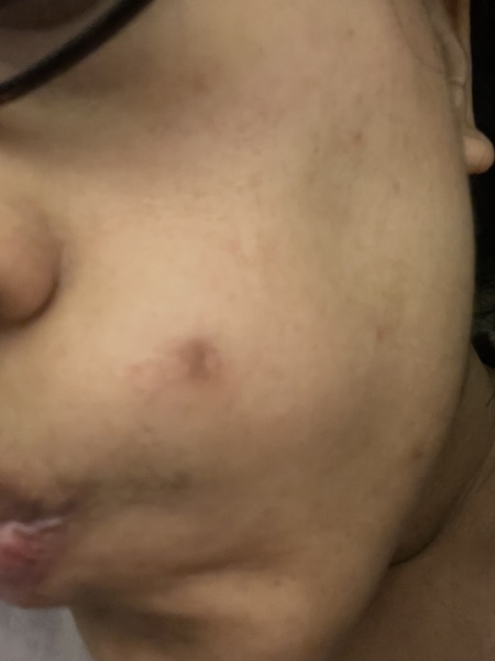Melanoma
