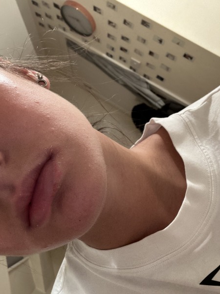DD lips swelling and dry....