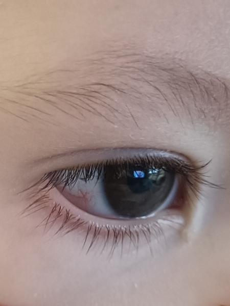 9MO bloodshot eye - pic included