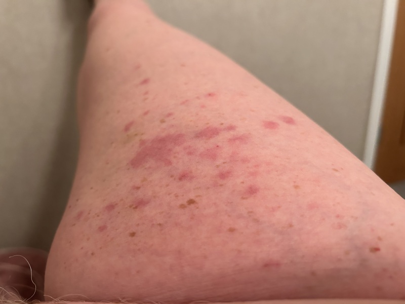 What is this rash?