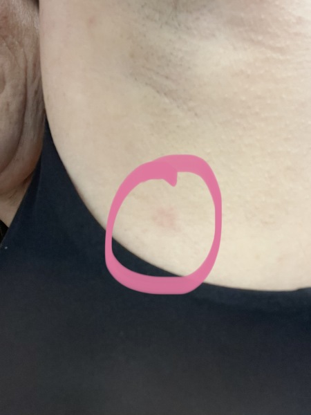 Red discoloured patch underneath armpit, pic included