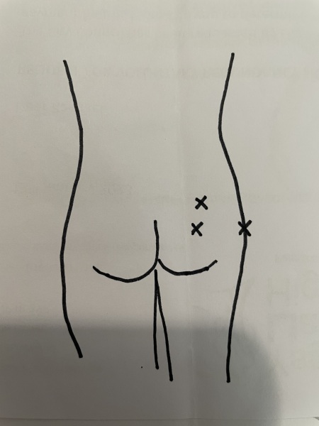Buttock/ lower back pain?