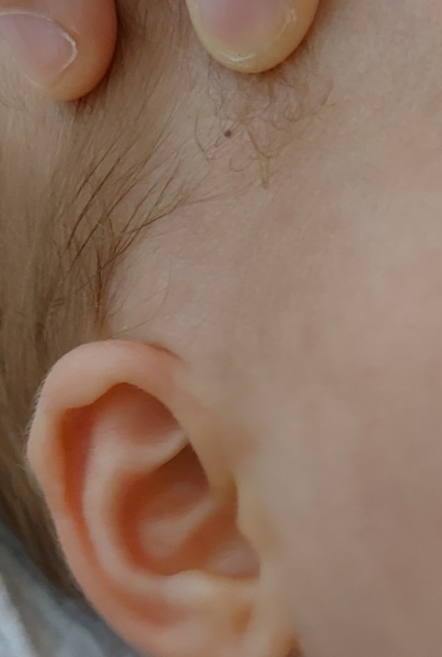 Dark spot/freckle/mole on babies head?