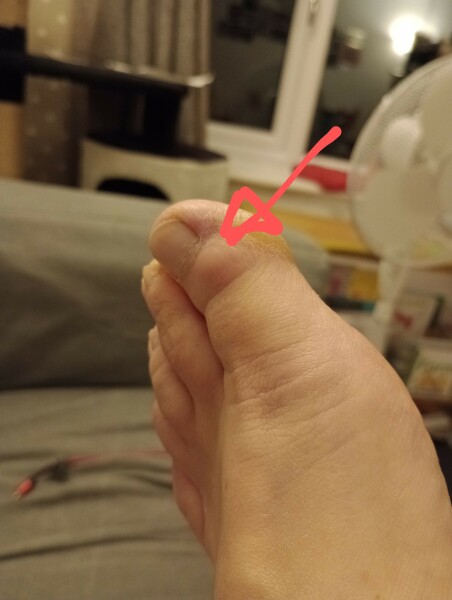 What is this on my toe