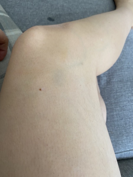 Do the veins in my legs look normal?