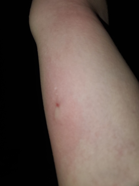 Weird lump suddenly appeared on arm by implant