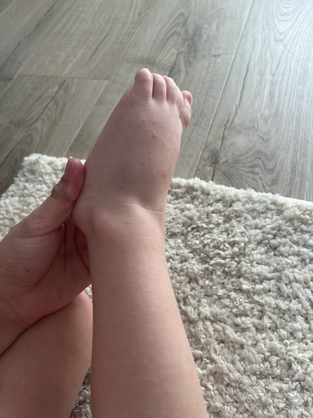 Toddler white rash