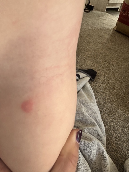 Is this chicken pox?