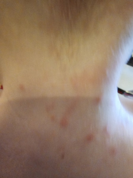 Rash on toddler for 5 weeks!!