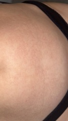 Weird patches on skin? Rash? Petechiae?